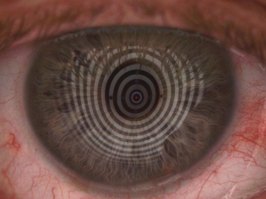 Anpassung von Kontaktlinsen bei Keratokonus – Augenoptik Truckenbrod